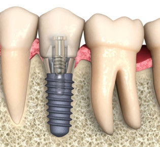 Как сделать имплант зуба?