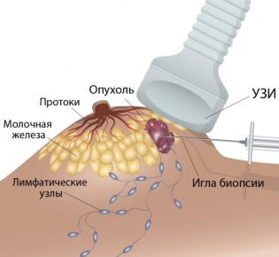 Биопсия молочной железы: необходимость и процедура