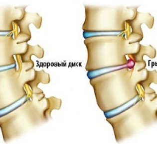 Грыжа межпозвоночного диска