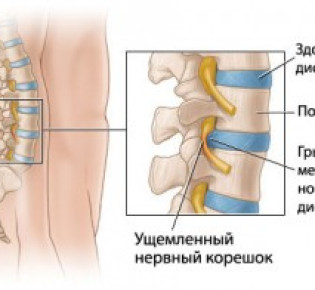 Грыжа позвоночника