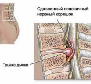 Грыжа поясничного отдела