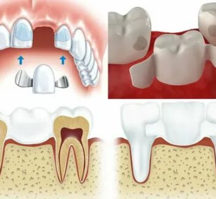 Виды зубных мостов