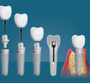 Виды зубных имплантов: ликбез и особенности конструкций