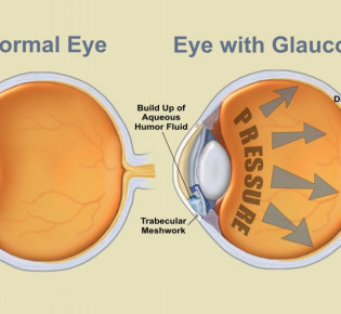 Как остановить глаукому? Питание, советы, лечение