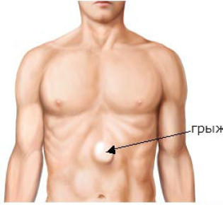 Грыжа белой линии живота