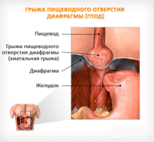 Грыжа пищеводного отверстия диафрагмы (ГПОД)