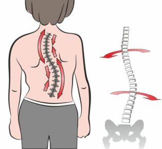 Сколиоз позвоночника: проблема, которую можно решить!