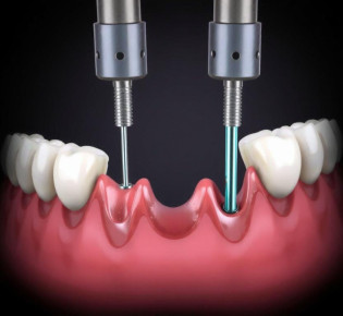 Базальная имплантация: решение для надежной реабилитации зубного ряда