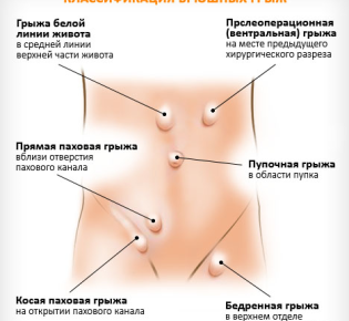 Грыжа живота