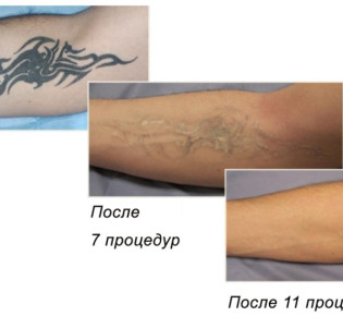 Как сводятся татуировки лазером?