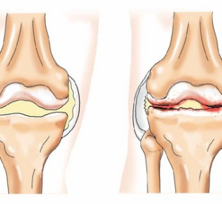 Артроз: симптомы, лечение, причины, виды