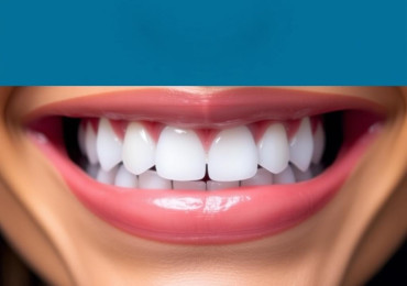 Отбеливание зубов: как получить белую улыбку без лишнего риска