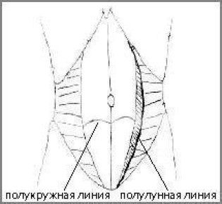 Грыжа полулунной спигелевой линии живота
