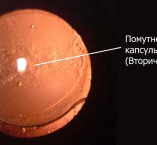 Вторичная катаракта, симптомы, виды