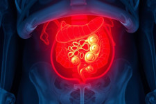 Острый парапроктит: как распознать, что делать и почему не стоит медлить