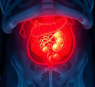 Острый парапроктит: как распознать, что делать и почему не стоит медлить