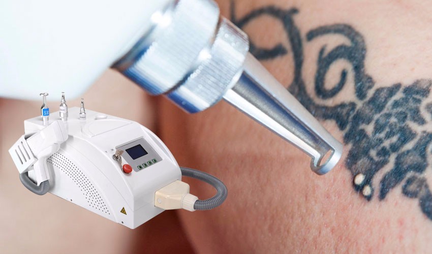 Как работают лазерные аппараты для удаления татуировок?