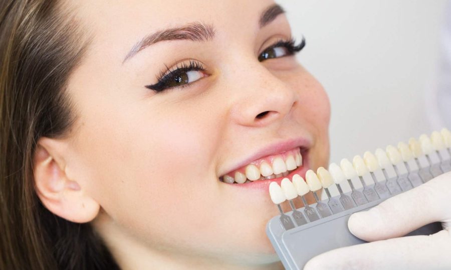 Что такое профессиональное отбеливание зубов?