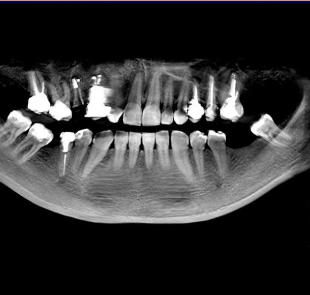 Что такое ортопантомограмма зубов?