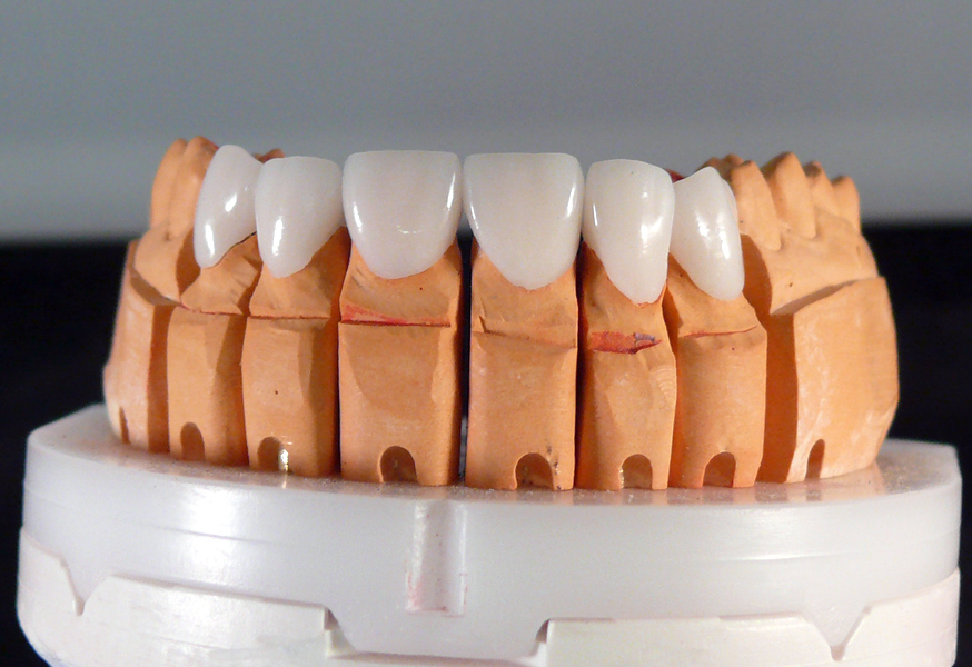 Особенности коронок и виниров для зубов