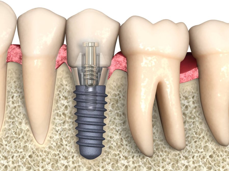 Как сделать имплант зуба?