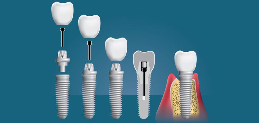 Виды зубных имплантов: ликбез и особенности конструкций