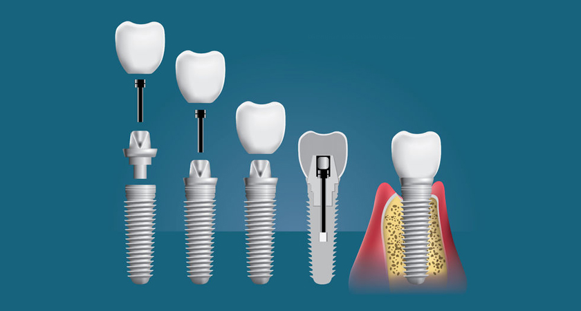 Виды зубных имплантов: ликбез и особенности конструкций
