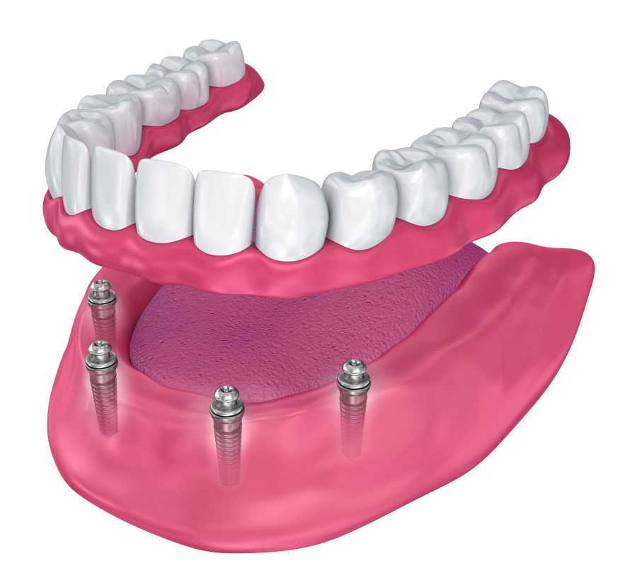 Что такое имплантация зубов на 4 имплантах?