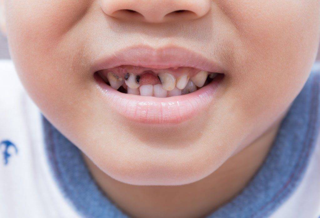 В какой стоматологии вылечить кариес у ребенка?