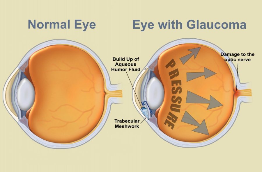 Как остановить глаукому? Питание, советы, лечение