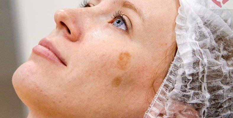Какой использовать крем от пигментных пятен на лице?