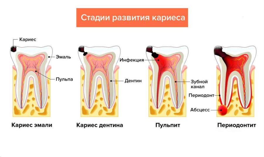 Проблемы при лечении пульпита молочных зубов