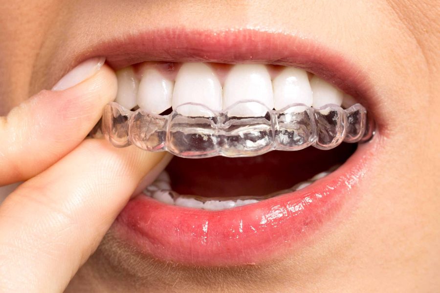 Выравнивание зубов без классических брекетов: современные методы ортодонтии