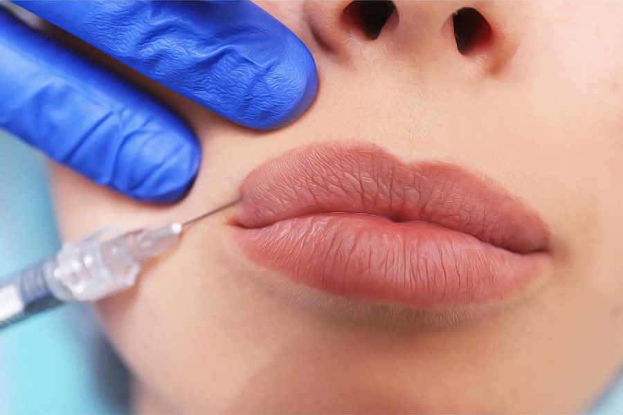 Контурная пластика губ: все, что вам нужно знать о процедуре