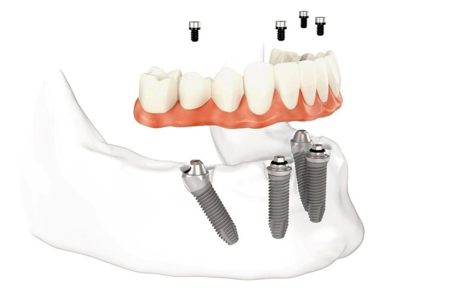 Имплантация All-on-4: полное восстановительное решение для зубов
